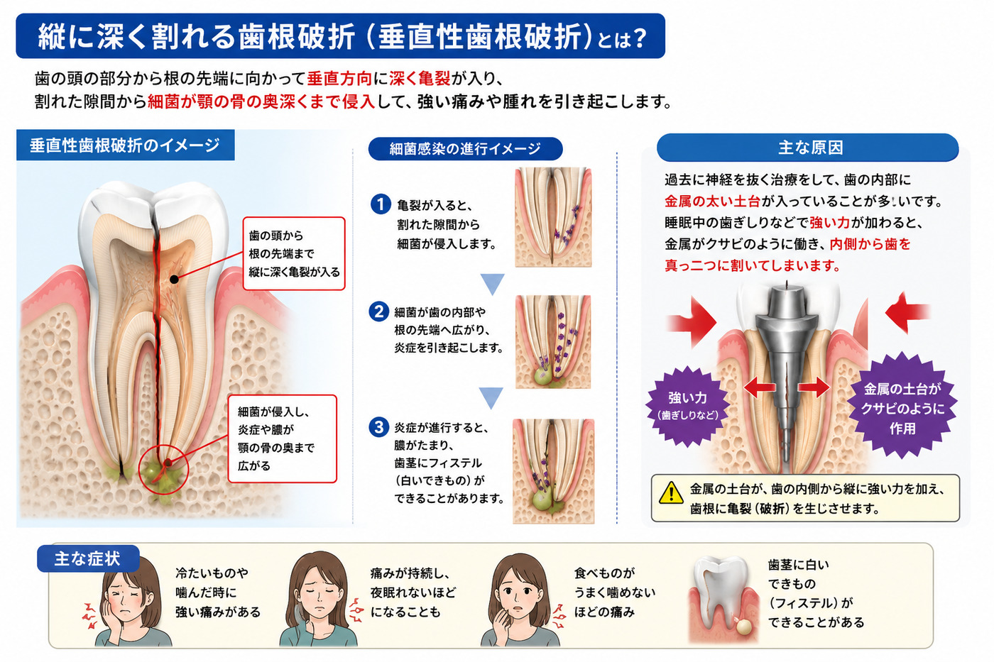 垂直性歯根破折（縦に深く割れる歯根破折）の解説図