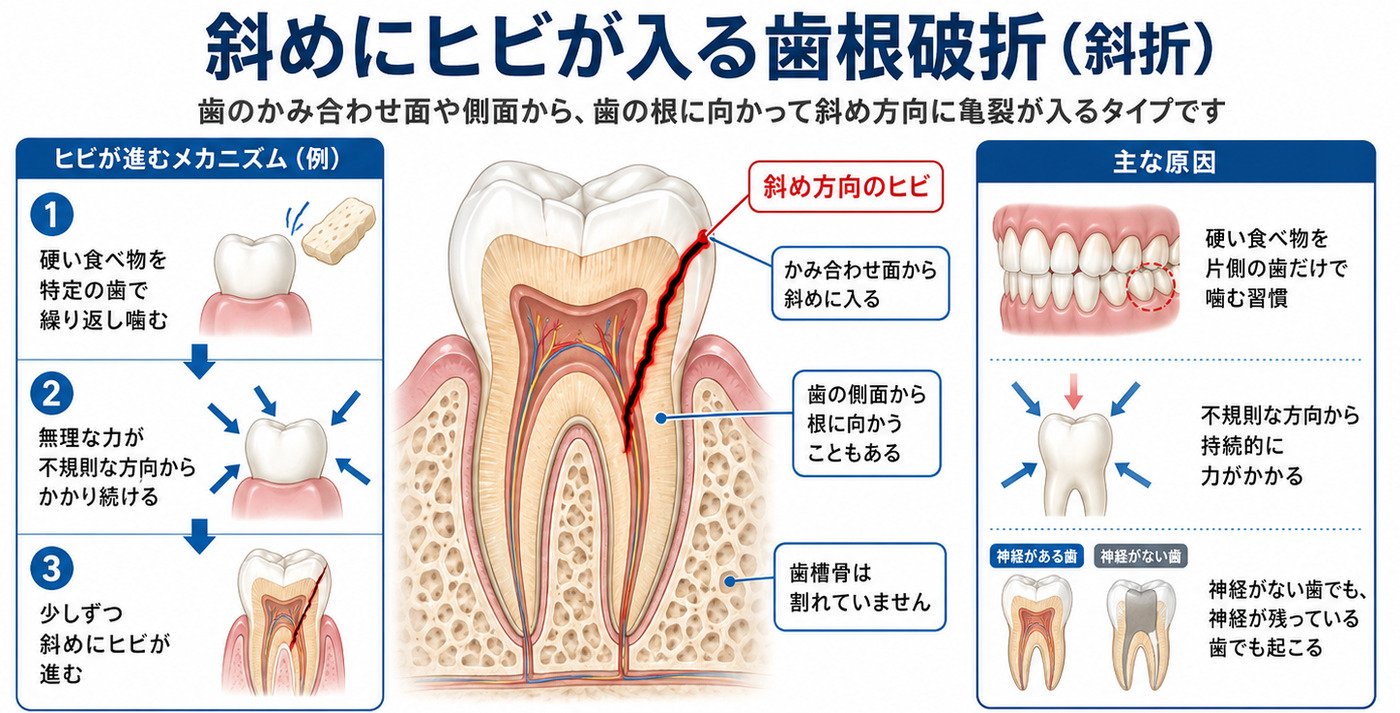 斜折（斜めにヒビが入る歯根破折）の解説図