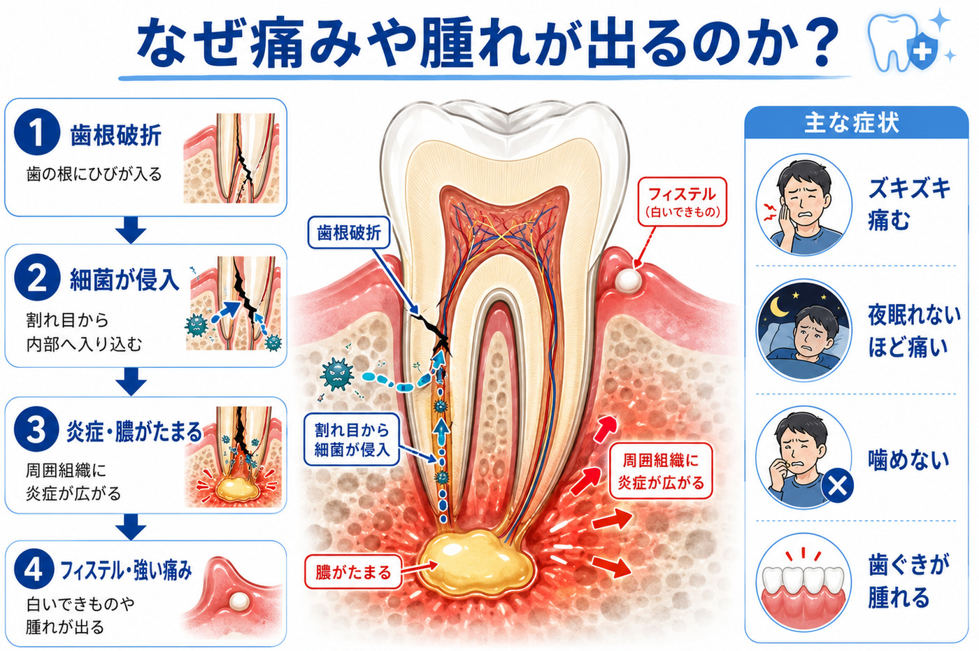 歯根破折で痛みや腫れ・フィステルが出るメカニズムの解説図