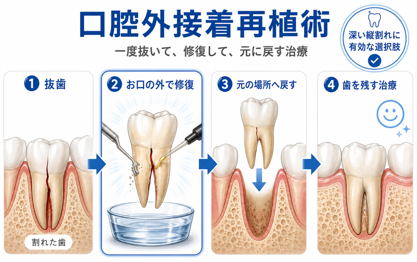 口腔外接着再植術の解説図
