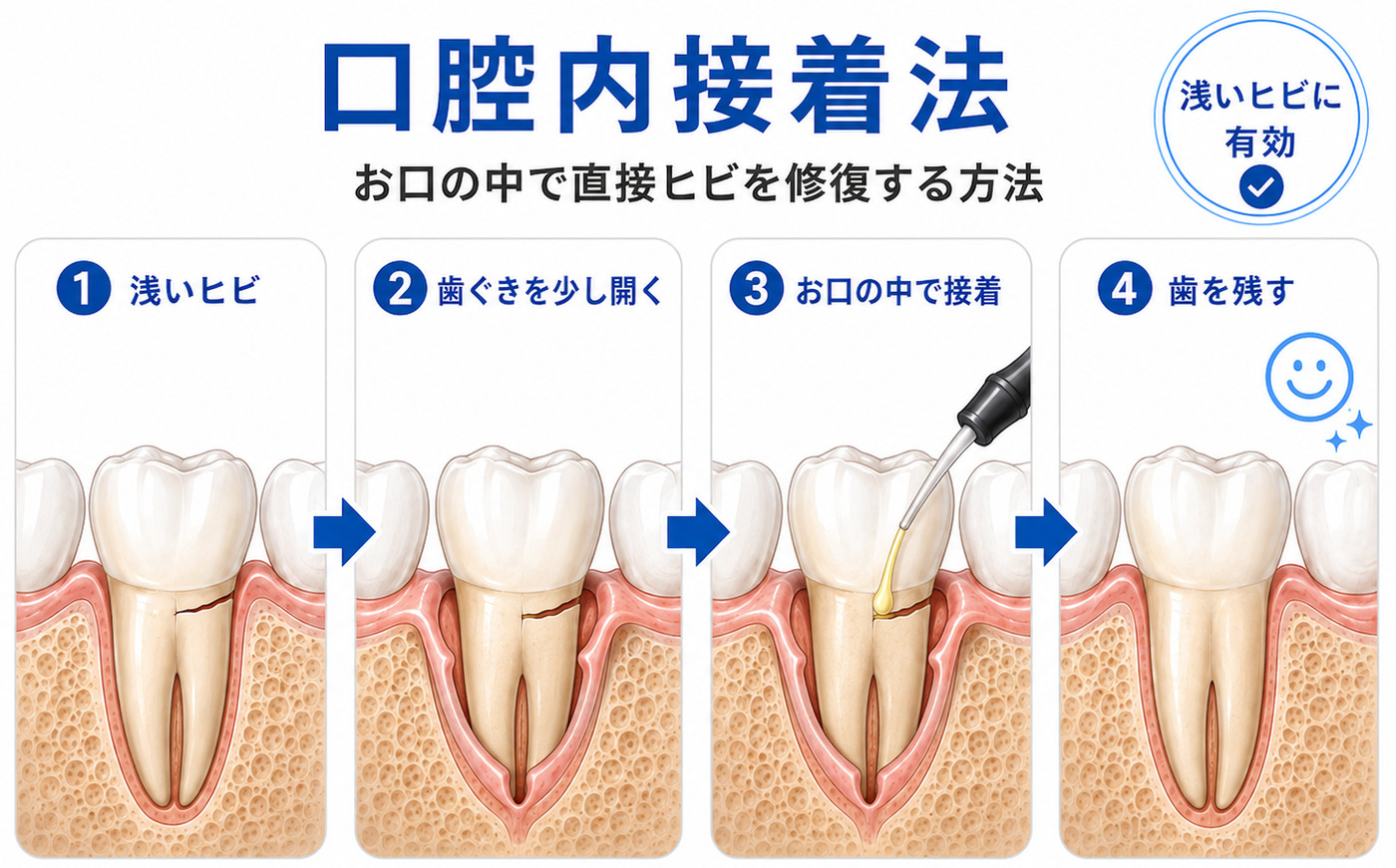 口腔内接着法の解説図