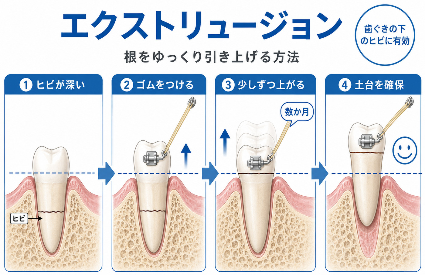 エクストリュージョン（矯正的挺出）の解説図