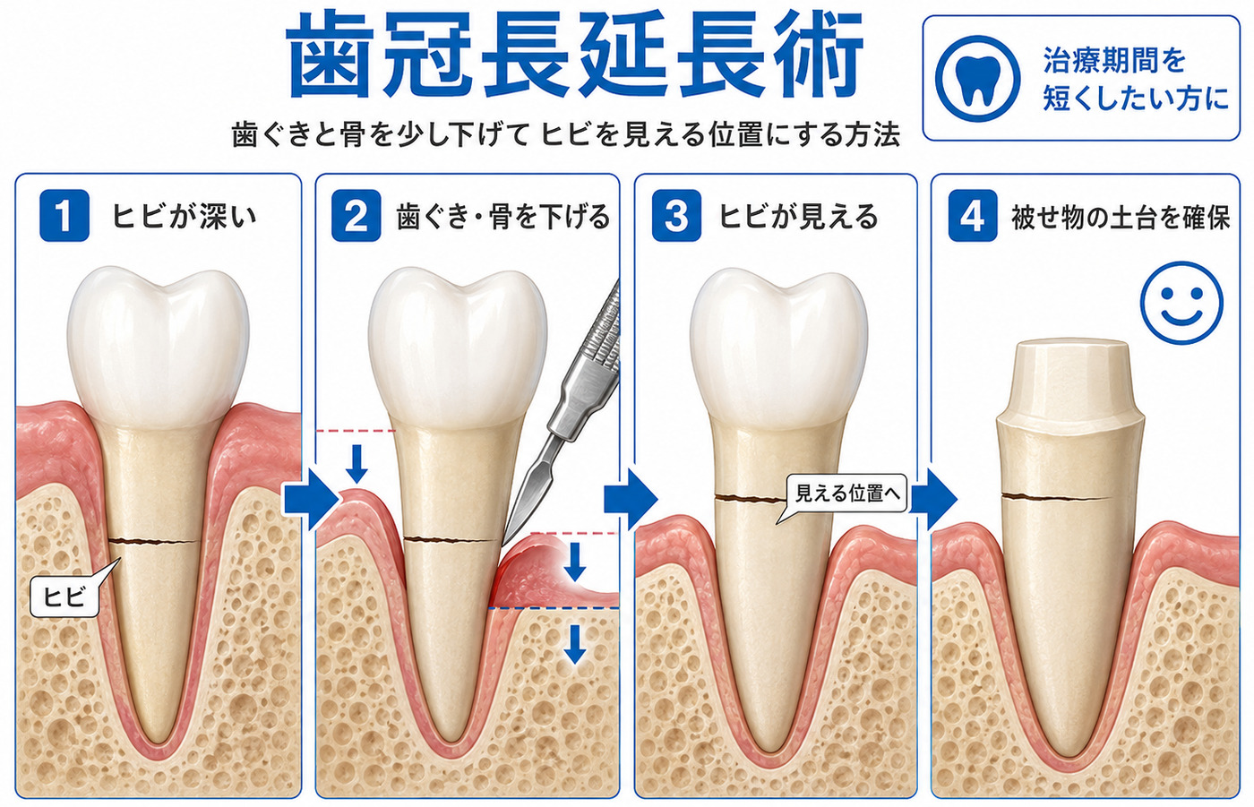 歯冠長延長術（クラウンレングスニング）の解説図
