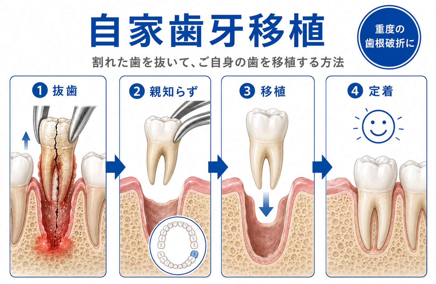 自家歯牙移植の解説図