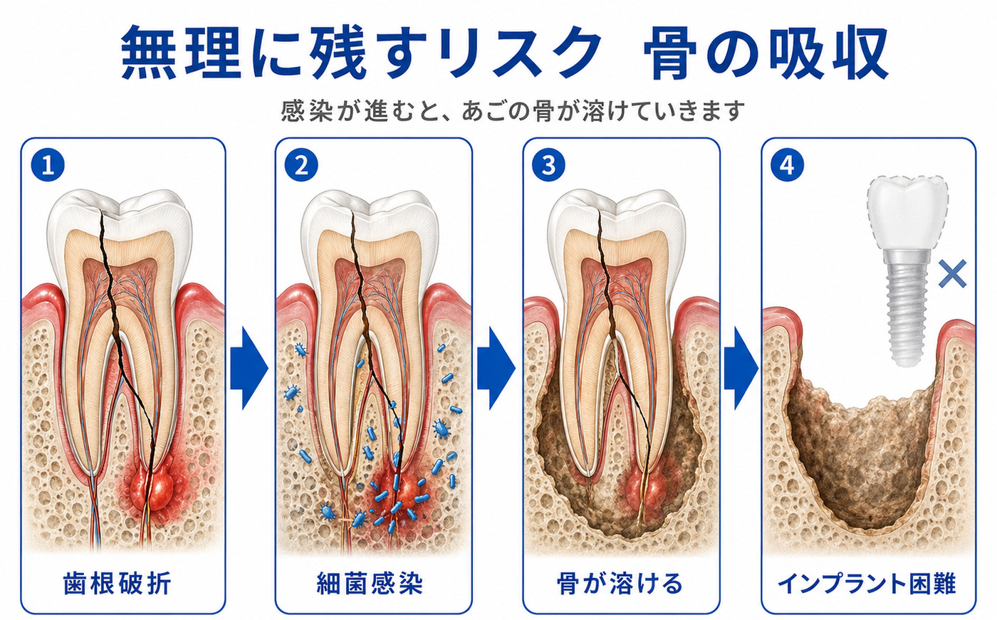 歯根破折を無理に残すことで生じる顎の骨の吸収